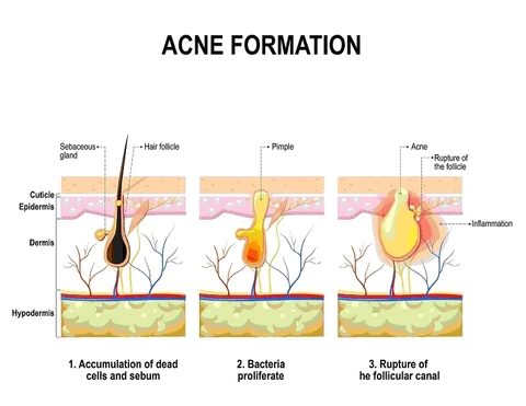 Genetics and Acne