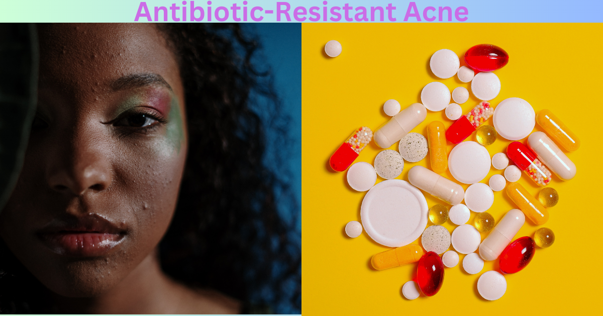 Topical Antibiotics & Acne: Understanding Resistance